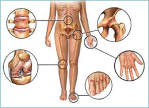 Quali sono le manifestazioni dell’artrite psoriasica